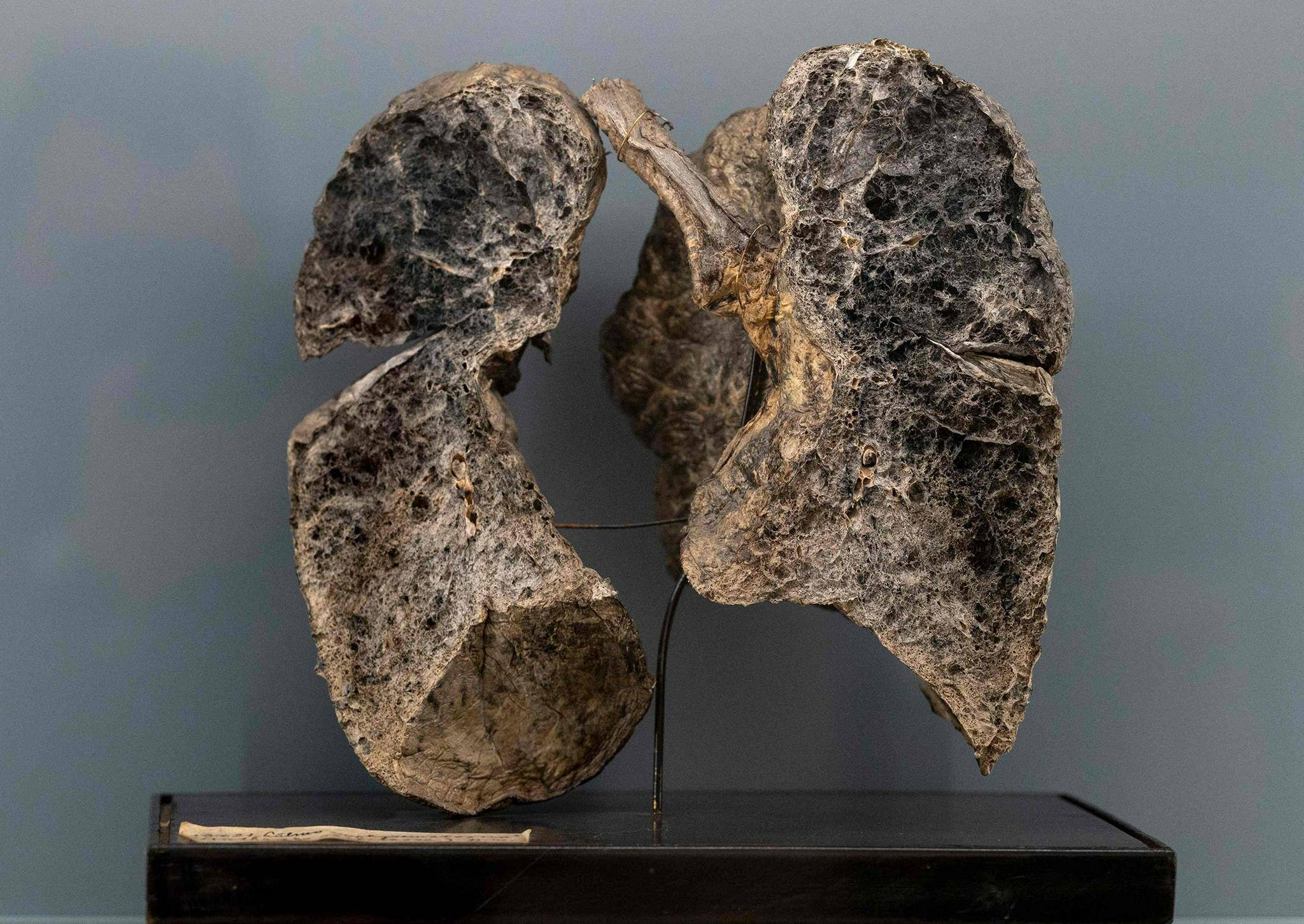 竞博APP下载注册：维也纳博物馆重新展出5万个人体器官包括肿大肝脏、畸形骨骼……(图2)